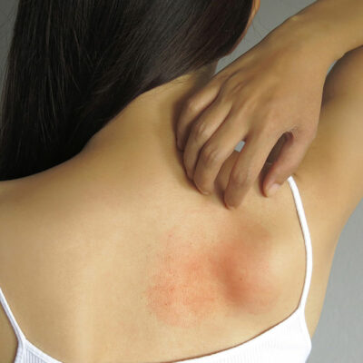 Skin allergy – An overview