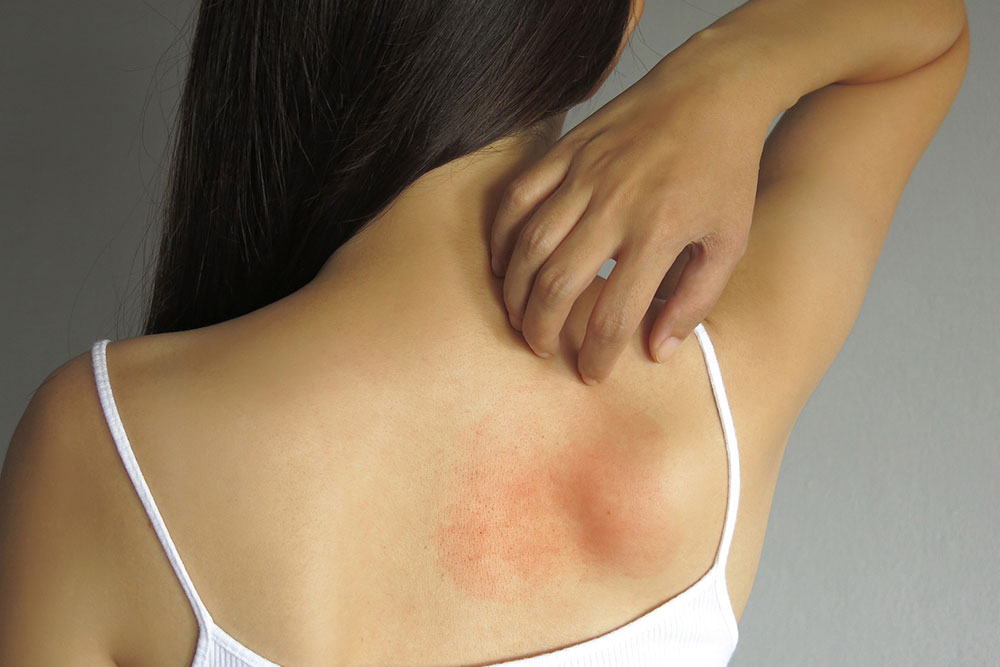 Skin allergy – An overview